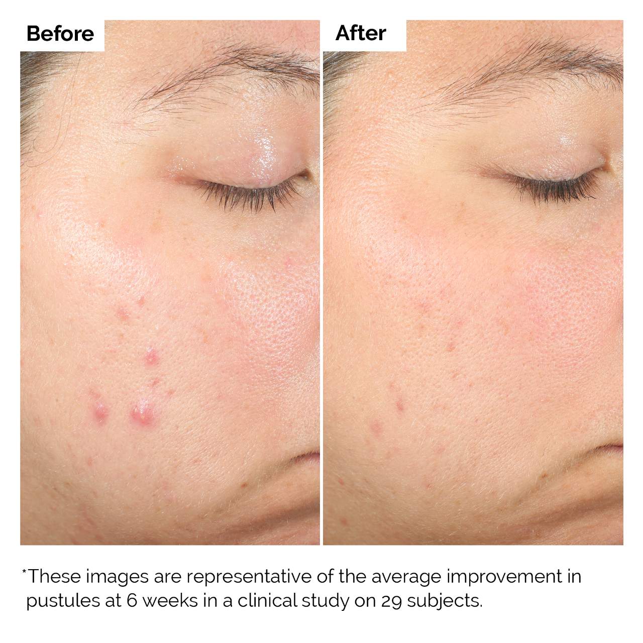 The Ordinary Salicylic Acid 2% Solution 30ml |Tratamiento Ácido Salicílico