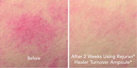 Rejuran Turnover Ampoule PDRN