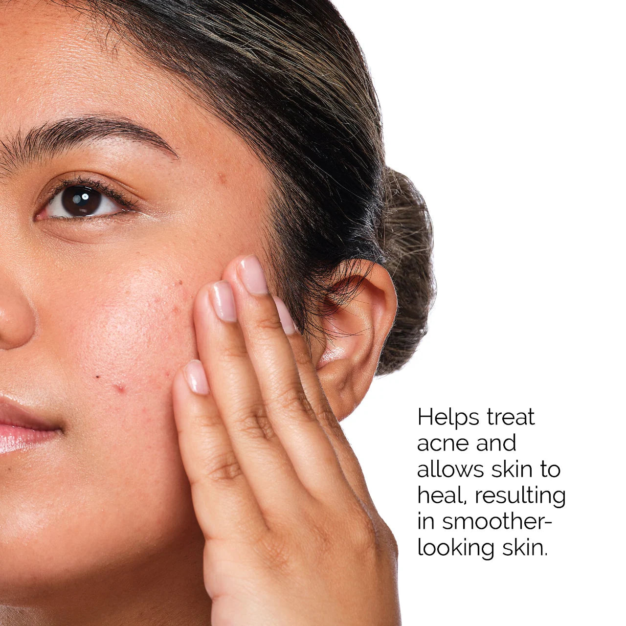 The Ordinary The Acne Set